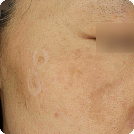 Before treatment