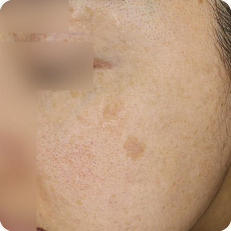 Before treatment