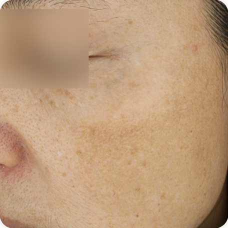 Before treatment