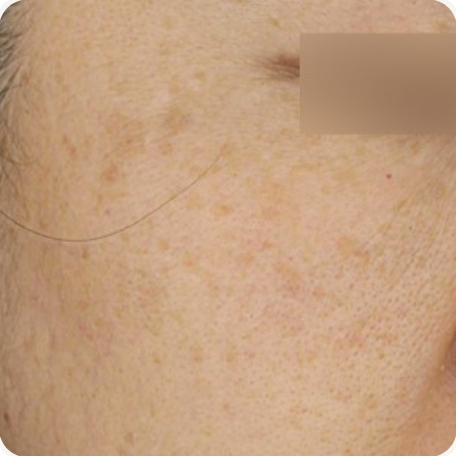 Before treatment