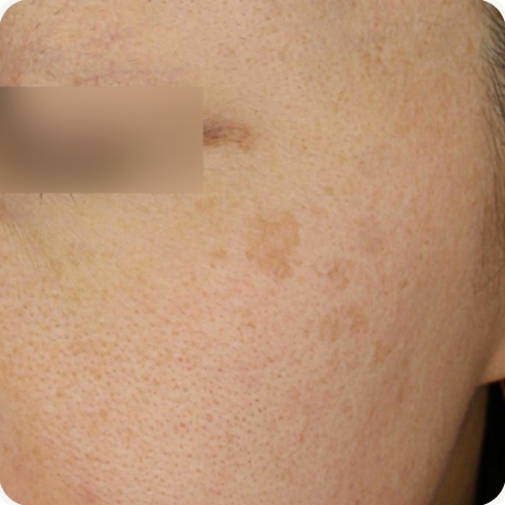 Before treatment