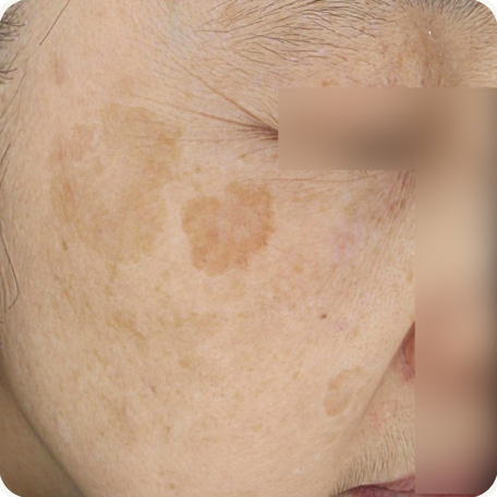 Before treatment