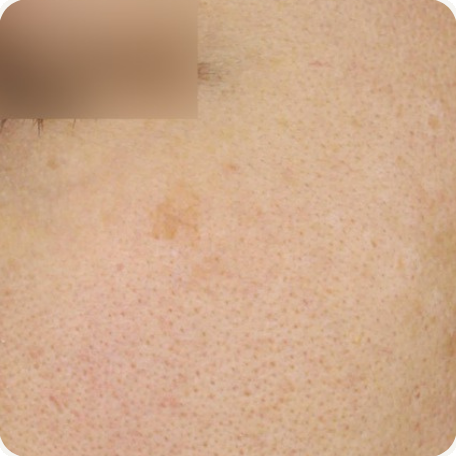 Before treatment