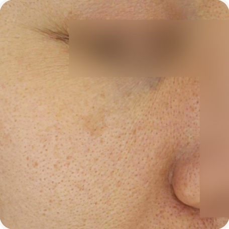 Before treatment