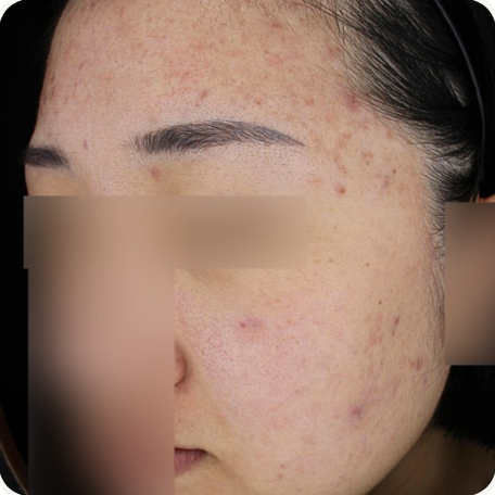 Before treatment