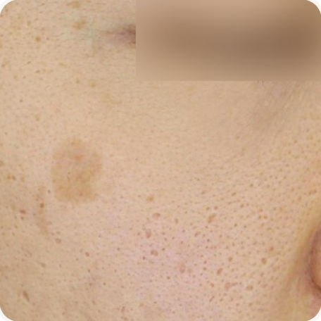 Before treatment