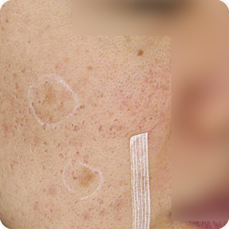 Before treatment