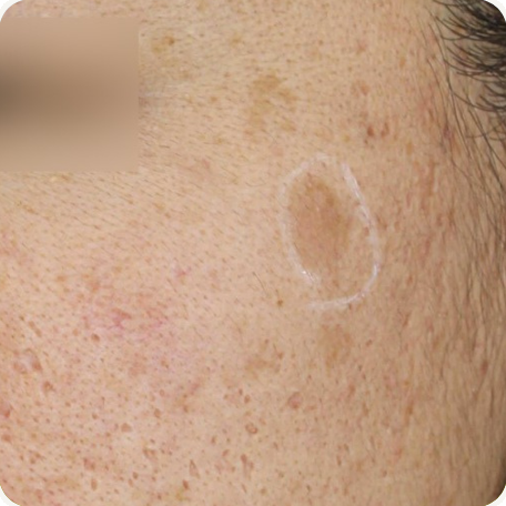 Before treatment