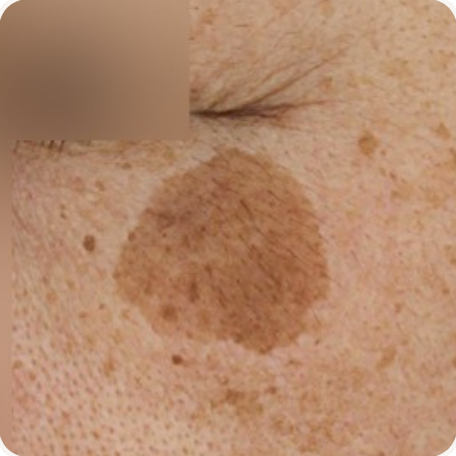 Before treatment