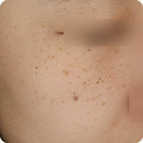 Before treatment