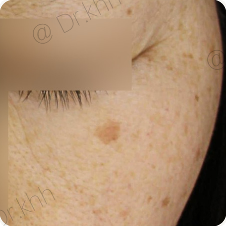 Before treatment