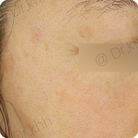 Before treatment