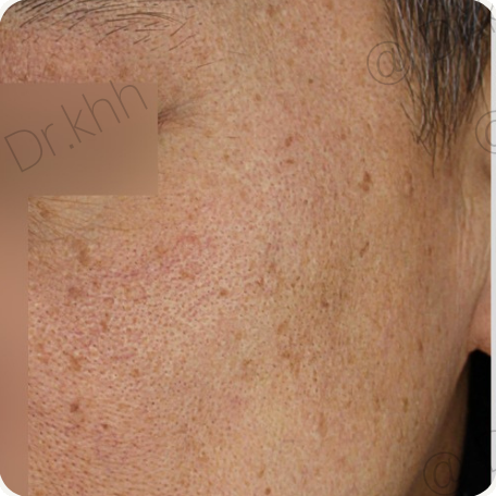 Before treatment