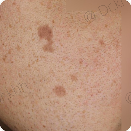 Before treatment