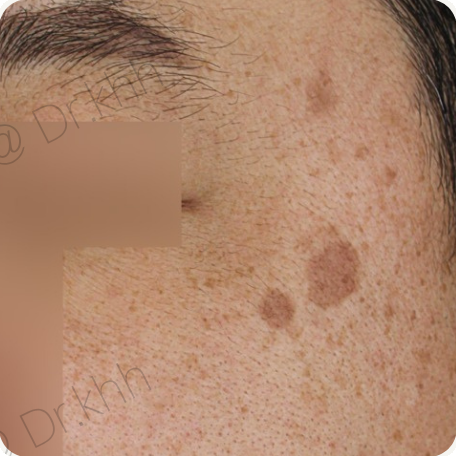 Before treatment