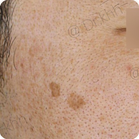 Before treatment