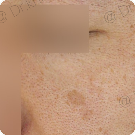 Before treatment