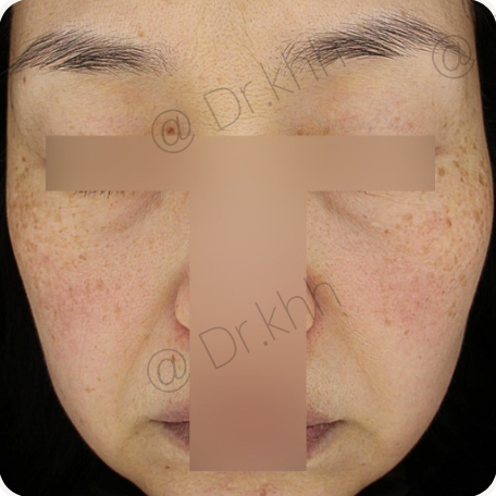 Before treatment