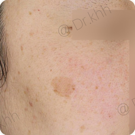 Before treatment