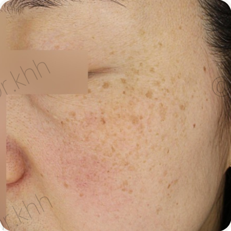 Before treatment
