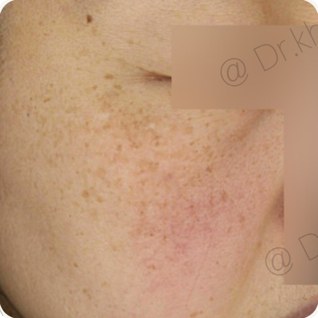 Before treatment