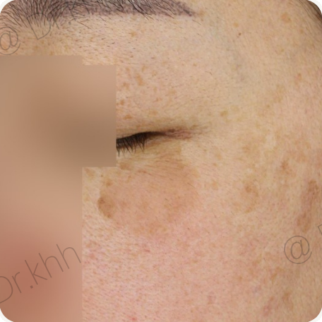Before treatment