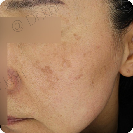 Before treatment
