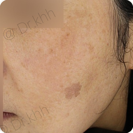Before treatment