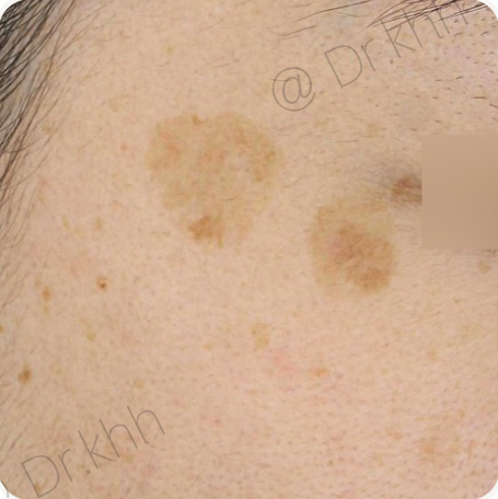 Before treatment