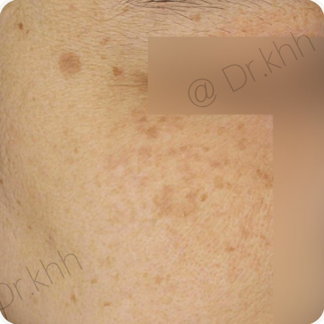 Before treatment
