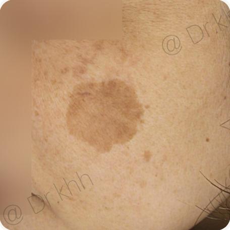 Before treatment