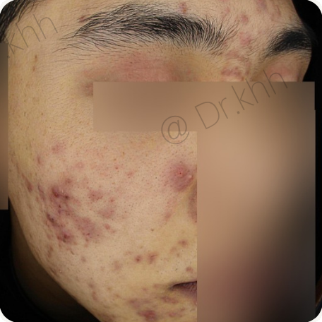 Before treatment