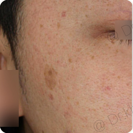 Before treatment