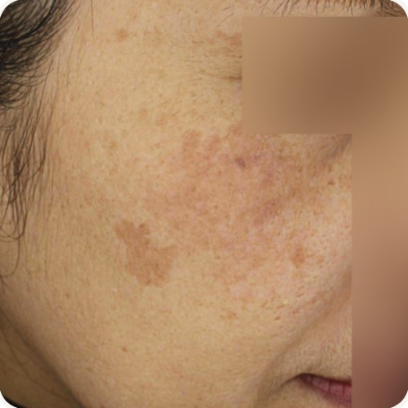 Before treatment