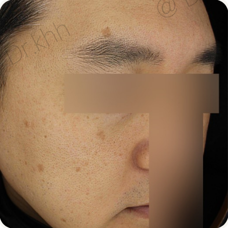 Before treatment