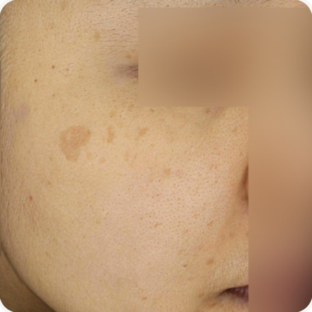 Before treatment