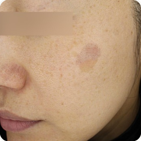 Before treatment