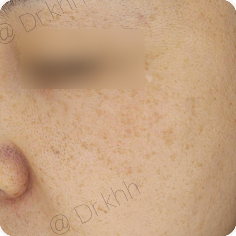 Before treatment