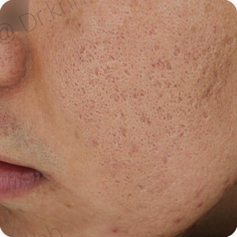Before treatment