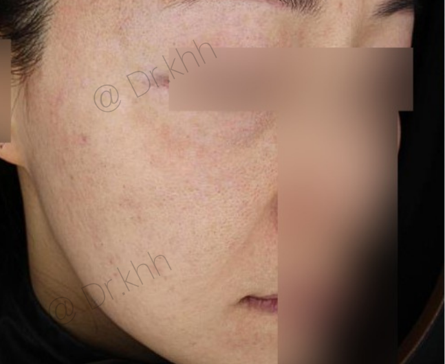 Before treatment