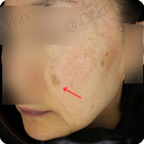 Before treatment