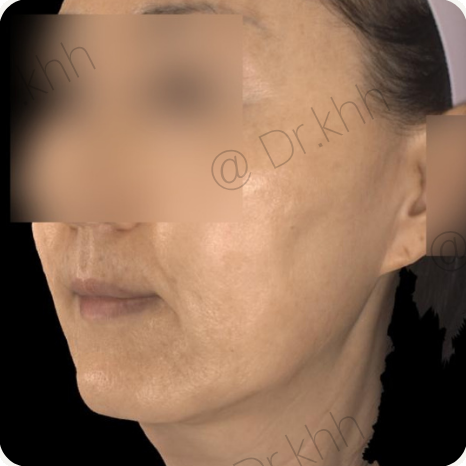 Before treatment