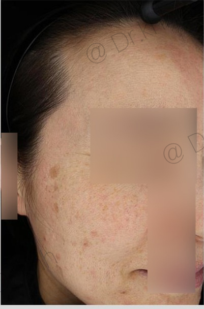 Before treatment