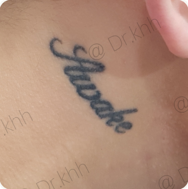 Before treatment