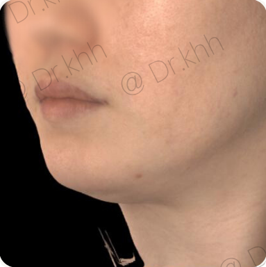 Before treatment