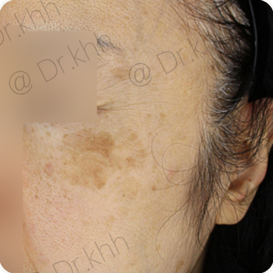 Before treatment