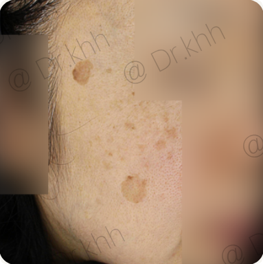 Before treatment