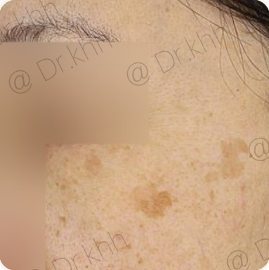Before treatment