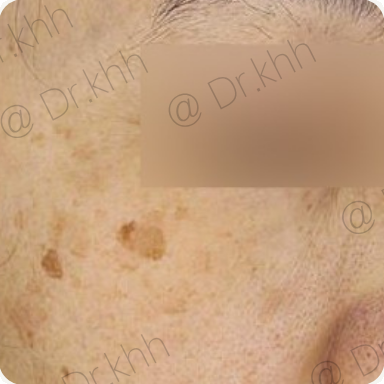Before treatment