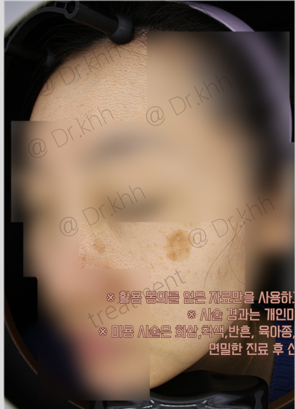 Before treatment